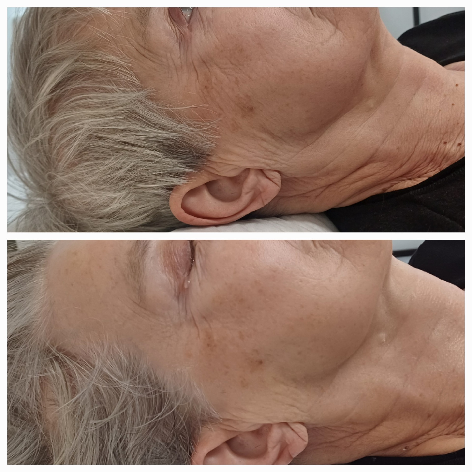 Arkana Neuro Gaba kohottava ja silottava kasvohoitokokonaisuus ennen ja jälkeen hoidon.